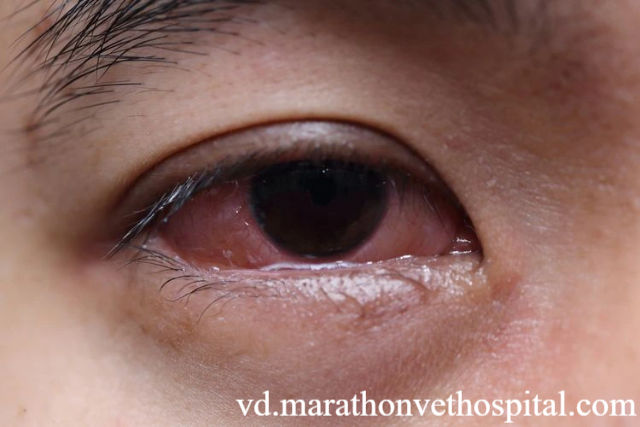 Berbagai Penyebab Mata Belekan yang Harus Diwaspadai