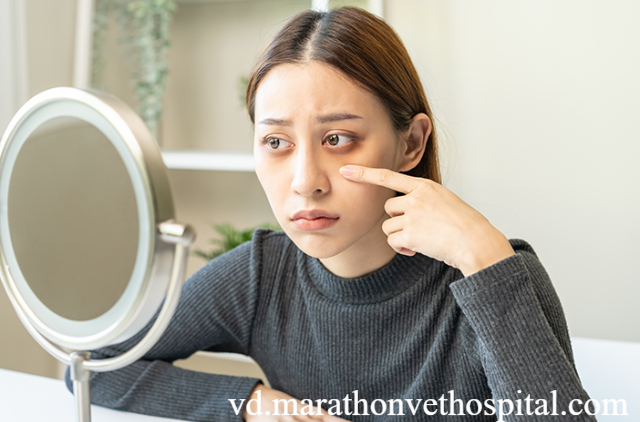 Gejala Mata Lelah dan Penanganannya