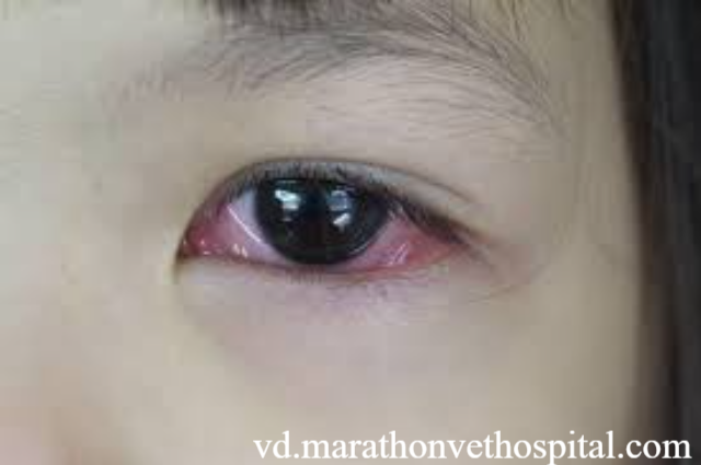 Ciri-Ciri Ada Cacing di Mata Anda dan Cara Mengobatinya