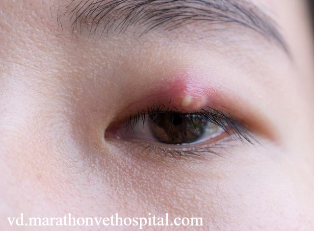 Pilihan Obat Bintitan Ampuh untuk Mempercepat Penyembuhan